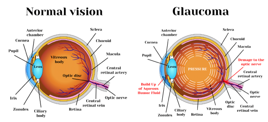 Daños provocados por el glaucoma