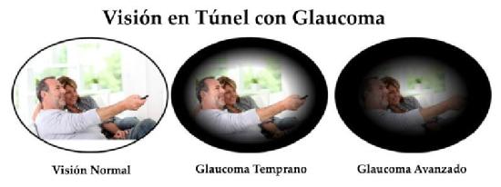 Visión túnel provocada por el glaucoma