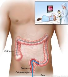 Colonoscopia prueba para detectar el cáncer de colon