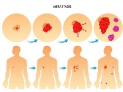 Imagen que muestra el proceso que siguen las células durante la metástasis