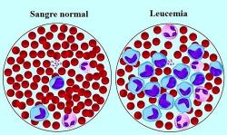 En esta imagen se puede ver la diferencia entre la sangre normal y la sangre con leucemia